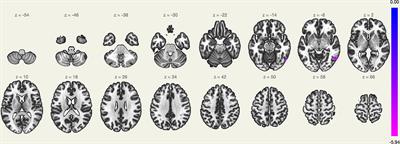 Alterations of Resting-State Locus Coeruleus Functional Connectivity After Transdermal Trigeminal Electrical Neuromodulation in Insomnia